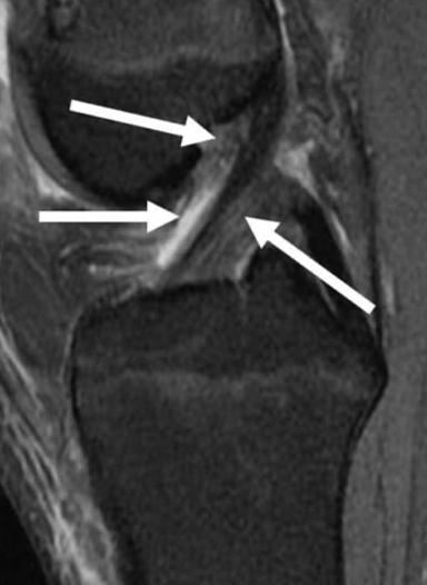 Large Tibial Tunnel on CT Scan for Failed ACLR
