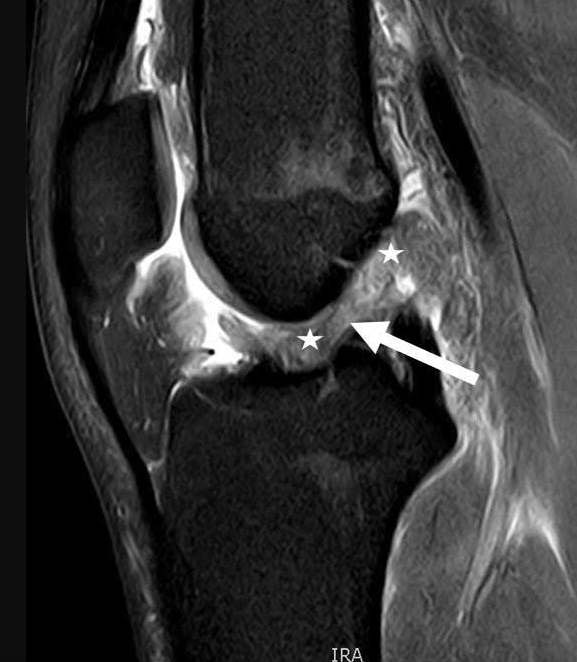 Large Tibial Tunnel on CT Scan for Failed ACLR