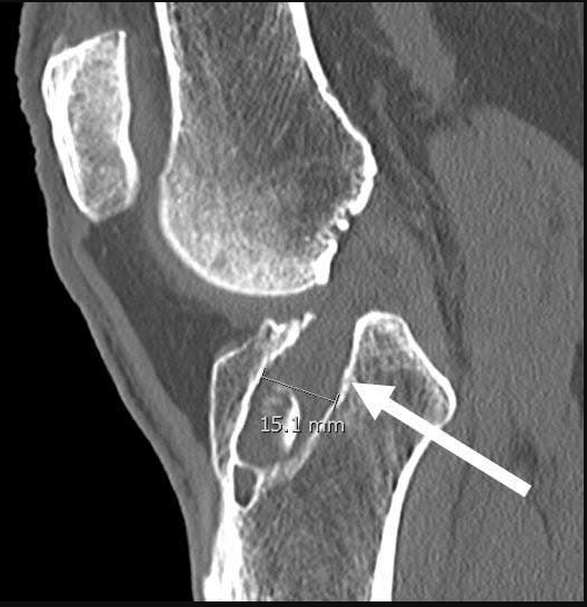 ACL Graft placed too Central on the Tibia