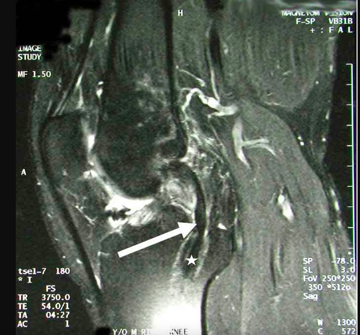 Failed PCL with Bad Tibial Tunnel Location