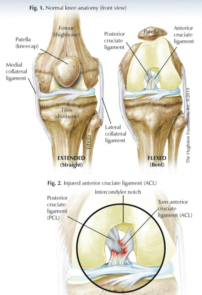 Large Tibial Tunnel on CT Scan for Failed ACLR