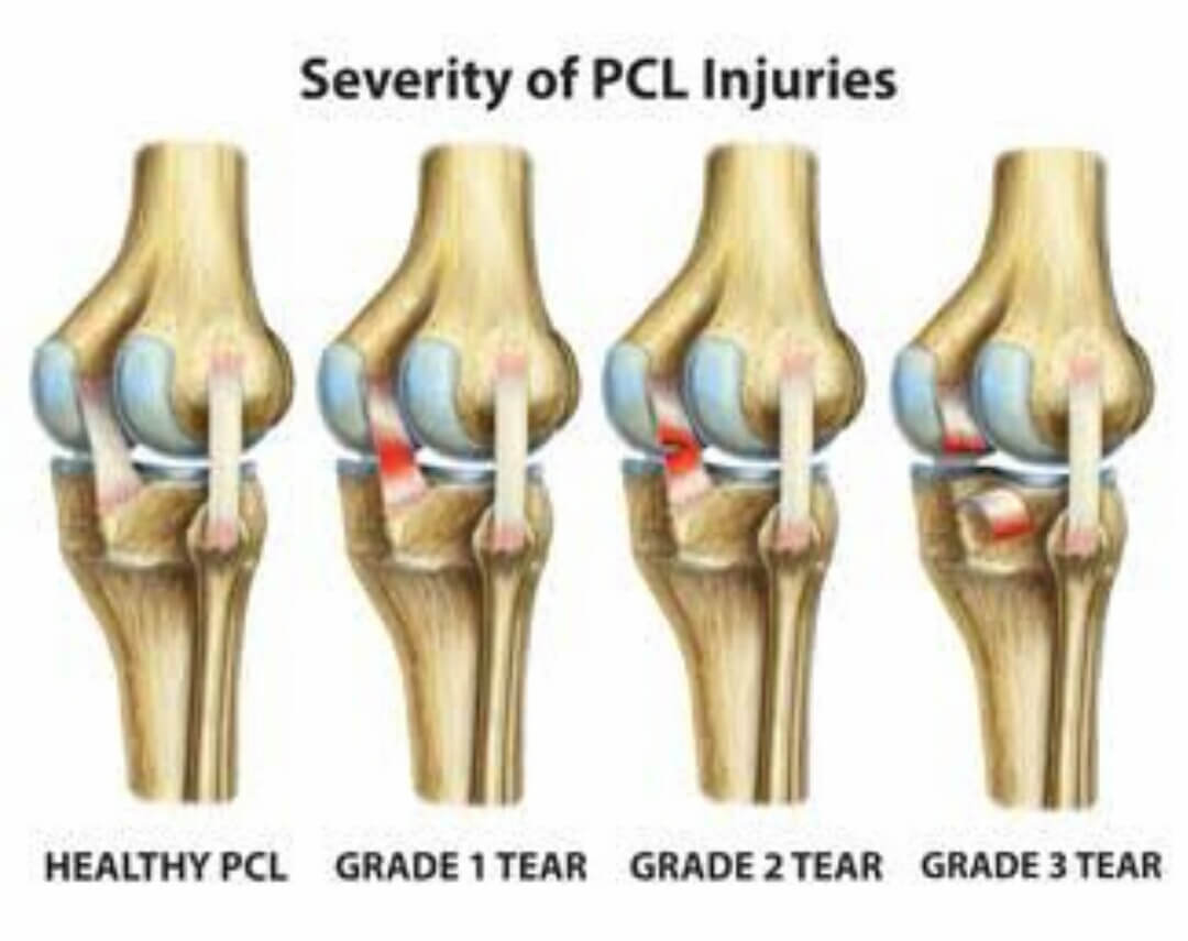 Failed PCL with Bad Tibial Tunnel Location