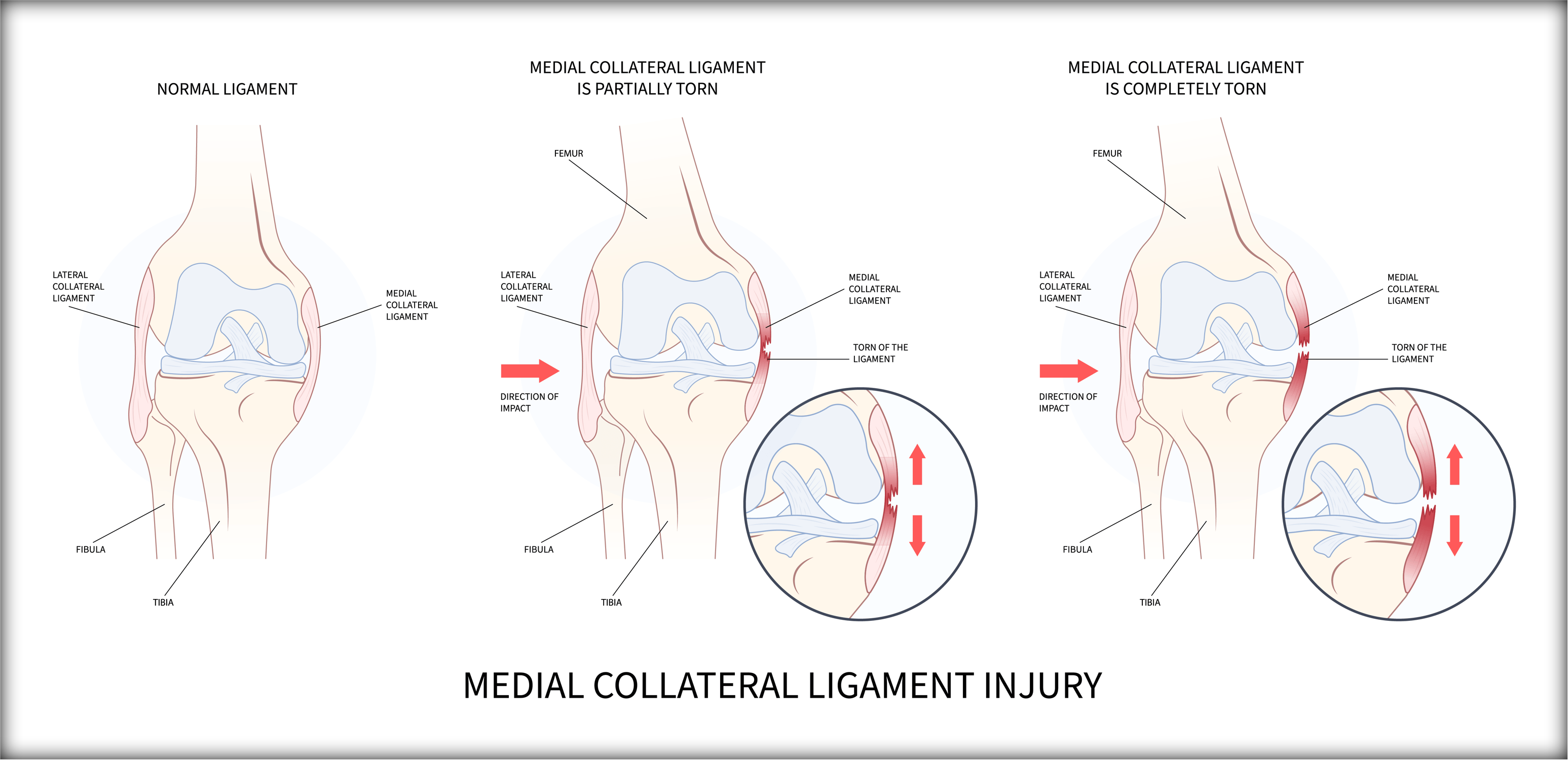 Failed PCL with Bad Tibial Tunnel Location