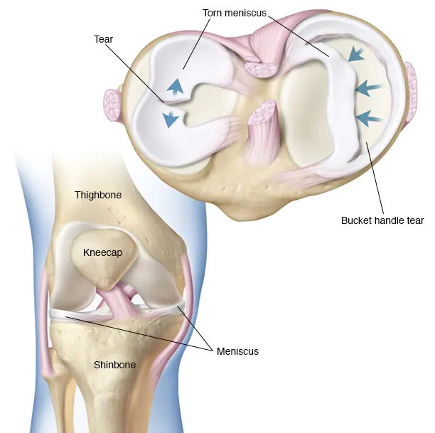 Failed PCL with Bad Tibial Tunnel Location