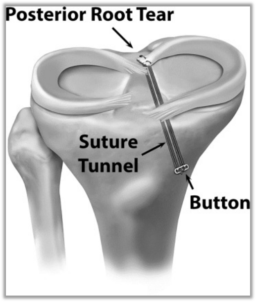 Failed PCL with Bad Tibial Tunnel Location