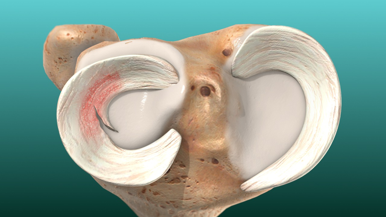 Failed PCL with Bad Tibial Tunnel Location