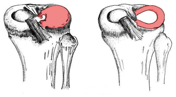 Failed PCL with Bad Tibial Tunnel Location