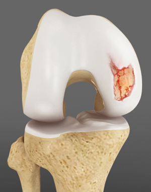 Large Tibial Tunnel on CT Scan for Failed ACLR