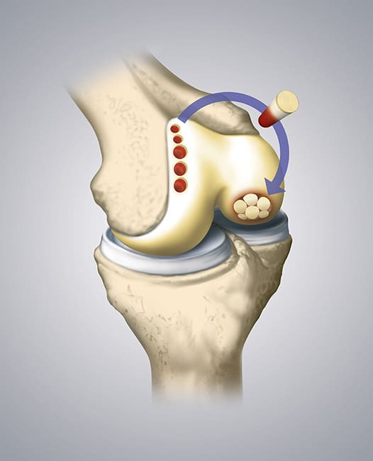 Failed PCL with Bad Tibial Tunnel Location