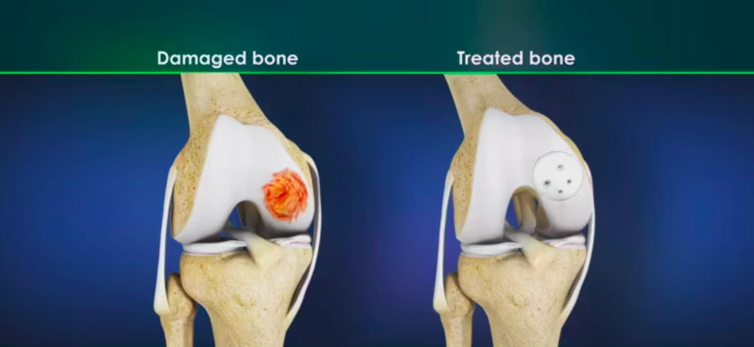 Failed PCL with Bad Tibial Tunnel Location