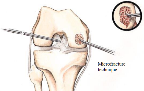 Failed PCL with Bad Tibial Tunnel Location