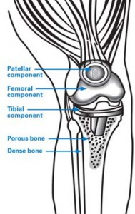 Lateral Knee X-ray of ACL Reconstruction Tunnels