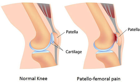 Large Tibial Tunnel on CT Scan for Failed ACLR