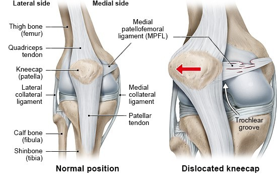 Large Tibial Tunnel on CT Scan for Failed ACLR