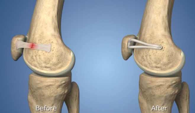 Large Tibial Tunnel on CT Scan for Failed ACLR