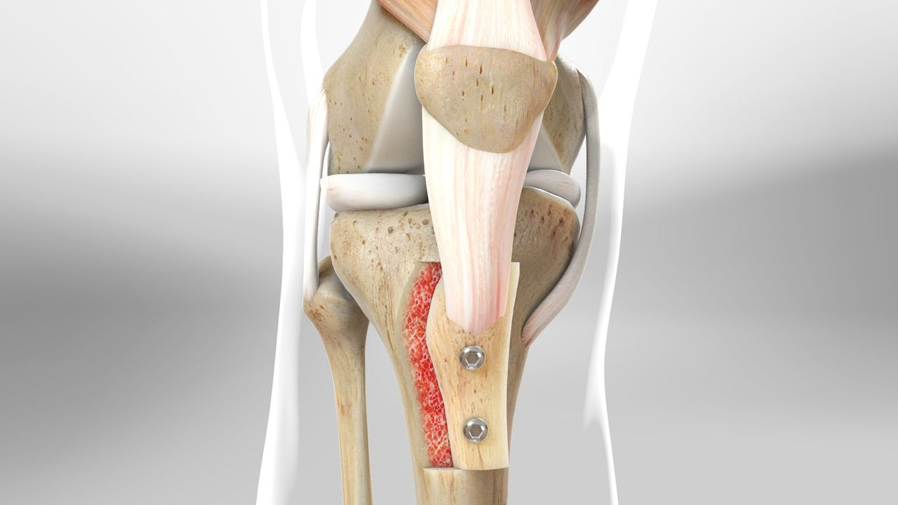 Large Tibial Tunnel on CT Scan for Failed ACLR