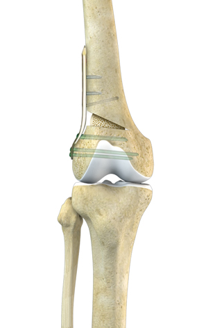 Large Tibial Tunnel on CT Scan for Failed ACLR