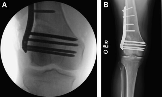 Large Tibial Tunnel on CT Scan for Failed ACLR