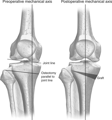 Large Tibial Tunnel on CT Scan for Failed ACLR