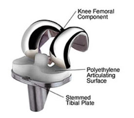 ACL Graft placed too Central on the Tibia