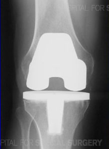 Lateral Knee X-ray of ACL Reconstruction Tunnels