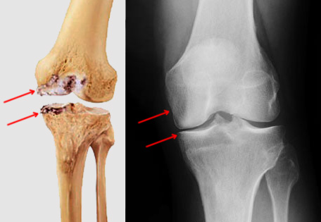 ACL Graft placed too Central on the Tibia